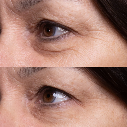 Vyon Lift - Adesivos de Efeito Lifting Rejuvenescedor
