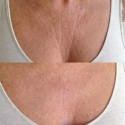 Vyon Lift - Adesivos de Efeito Lifting Rejuvenescedor